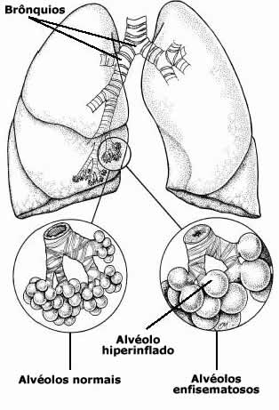 O enfisema é uma doença pulmonar crônica e progressiva que envolve lesão nos alvéolos.